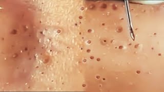 Satisfying and relaxing blackhead removal 2024  Pimples Removal home remedies  Blackheads [upl. by Aneeled66]