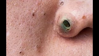 Nose Blackheads Chin Zits and Biggest Pimples  Top 10 Searches [upl. by Aileno]