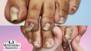 👣Curling Wavy PINCHING TOENAILS How to Clean amp Restore👣 [upl. by Letitia]