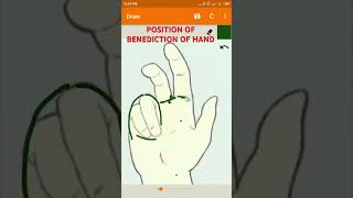 Position of Benediction of Hand UPPER LIMB ANATOMY lumbricalsinjury [upl. by Speroni954]