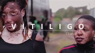 Elkanah  VITILIGO Official Music Video [upl. by Paucker]