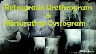 RGU MCU Retrograde Urethrogram and Micturating Cystogram Case Interpretation [upl. by Sigler880]