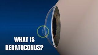 Keratoconus Symptoms and Treatment options [upl. by Heyward976]