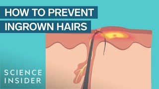 What Are Ingrown Hairs — And How To Treat Them [upl. by Kennett]