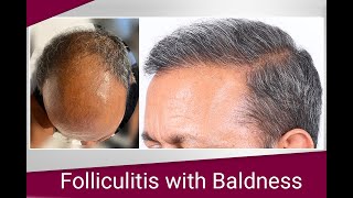 Folliculitis with Baldness Eugenix Hair Sciences [upl. by Rehpotsihc]