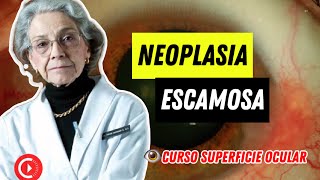 CURSO SUPERFICIE OCULAR ➡️ NEOPLASIA ESCAMOSA Dra Carmen Barraquer [upl. by Haleelahk]