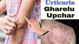 pitti uchalne par kya karte hain  urticaria ayurvedic treatment in hindi  pitti ka gharelu ilaj [upl. by Ayihsa609]