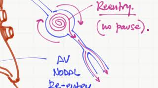 Taquicardia supraventricular vs ventricular [upl. by Murry61]