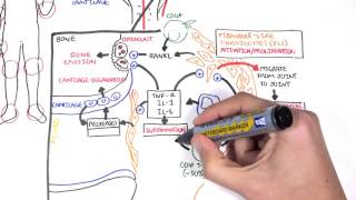 Rheumatoid Arthritis Pathophysiology signs and symptoms [upl. by Durning383]