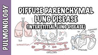 Interstitial Lung Disease ILD  Classification pathophysiology signs and symptoms [upl. by Tarrant]