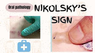 Nikolskys signunderstanding terms in dentistryoral pathologydental oralpathology video exams [upl. by Armando]