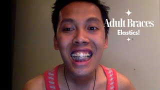 ADULT BRACES UPDATE PT4 misplaced midline  elastics  Randy and Michael [upl. by Aciretnahs]