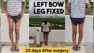 45 years old Man from Qatar fixed Left bow leg planning for second bow leg surgery [upl. by Aivlys84]