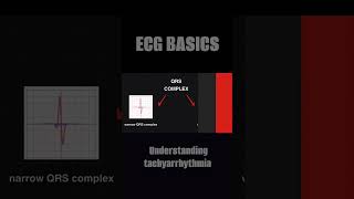 ECG BASICS  Understanding tachyarrhythmia tachycardia svt ventriculartachycardia ecg ecgbasics [upl. by Jinny]