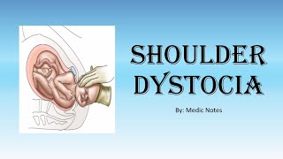 OampG Shoulder dystocia  definition risk factors sign management HELPERRR drill complications [upl. by Samuel751]