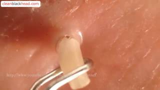 Blackhead Removal Tool  Popping Whiteheads and Blackheads Close Up [upl. by Hamilah]