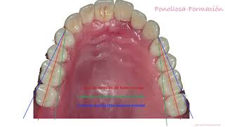 MONTAJE DE DIENTES PRÓTESIS COMPLETA SUPERIOR [upl. by Oihsoy]