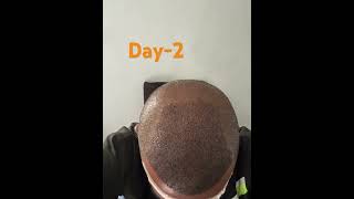 Hair transplant day 2 trending viralvideo shortfeed youtubeshorts hairtransplant hair [upl. by Ecydnak]