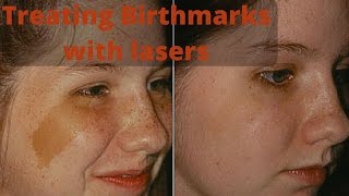 How to treat birthmarks [upl. by Alethia]