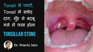 TONSILLAR STONETonsil मै पथरी मुँह से बदबू गले में दर्द  tonsil में सफ़ेद दाग  गले मैं फसा होना [upl. by Einaeg253]