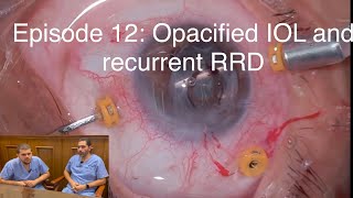 Retina Chats Episode 12 Opacified IOL and recurrent retinal detachment [upl. by Hteik]