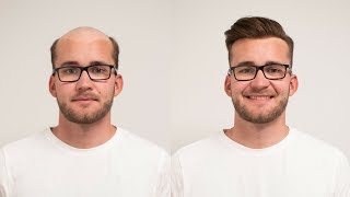 Sofortlösung bei Haarausfall mit Haarsystem  Haar Transformation  Hairsystems Heydecke [upl. by Lefton]