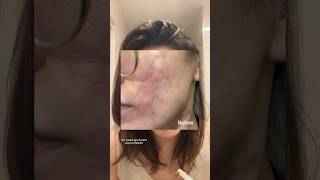 10 Sulfur Mask for AcneProne Rosacea Skin De La Cruz  Skincare Hacks acne rosacea [upl. by Mayce]