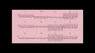 Reading the 12lead ECGEKG  six quick steps [upl. by Aisiram]