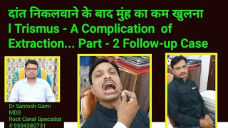 दांत निकलवाने के बाद मुंह का कम खुलना । Trismus  A Complication of Extraction Part 2 Followup [upl. by Ethelin]