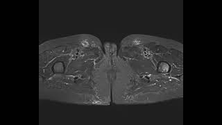 Atypical fracture hip both [upl. by Yelkao345]