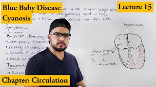 Cyanosis  Blue baby  Cardiovascular disorders  Chapter Circulation video 15 [upl. by Donohue834]