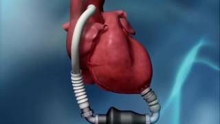 HeartMate II LVAD Animation [upl. by Surad]