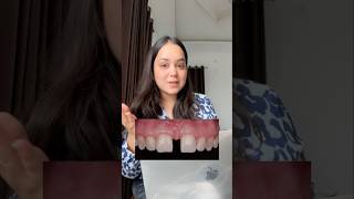 Midline Diastema gap between teeth  subscribe for complete video 👉🏻✅trending oralhealth teeth [upl. by Wong]