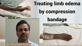 Treating limb edema by compression bandage [upl. by Collum]