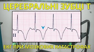 ЦЕРЕБРАЛЬНІ ЗУБЦІ Т ЕКГ при мозкових катастрофах Підвищення ВЧТ та ЕКГ [upl. by Shultz855]