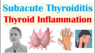 Subacute Thyroiditis Thyroid Inflammation De Quervain’s  Causes Symptoms Diagnosis Treatment [upl. by Roby]