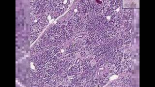 Histopathology Pancreas   Adenocarcinoma [upl. by Fitalludba]