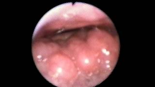 Epiglottis Schnarchen [upl. by Assiron]