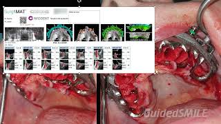 GuidedSMILE Dentate Natural Single Maxillary  Hamill [upl. by Nitsed]