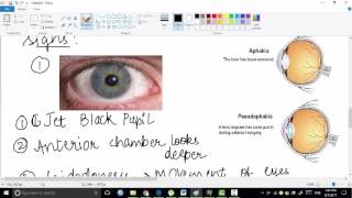 aphakia  ophthalmology [upl. by Greenleaf]