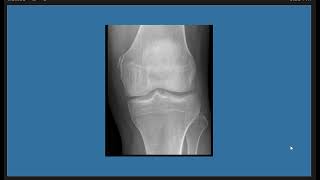 Short Case Discussion  PellegriniStieda lesion [upl. by Nnednarb]