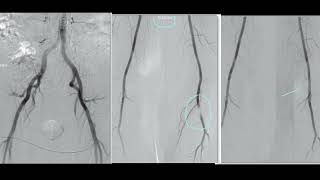 Catheter Angiogram of the Lower Limbs Identifying Popliteal Artery Anomalies FRCR2B [upl. by Mutz676]