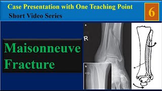 Maisonneuve Fracture Case Presentation with One Teaching Point [upl. by Rekyr]