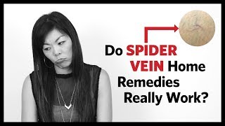 Spider Vein Home Treatment  Before and After Results [upl. by Asihtal]