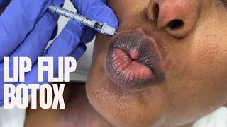 Lip Flip Botox Before amp After Gummy Smile [upl. by Ynor]