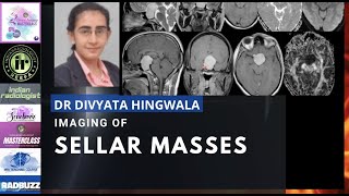 IMAGING OF SELLAR MASSES  DR DIVYATA HINGWALA  MRI TEACHING COURSE  PITUITARY MICROADENOMA [upl. by Nannahs]