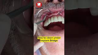 How to floss under Implant Bridge with superfloss flossing dentalcare dentalimplants shorts [upl. by Millie]