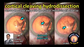 CataractCoach 1065 cortical cleaving hydrodissection in cataract surgery [upl. by Lindberg986]