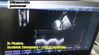 Signo sinusoide en ultrasonido pulmonar [upl. by Annahc]