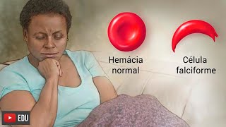 Anemia falciforme o que é sintomas causas e tratamento [upl. by Ydaj]